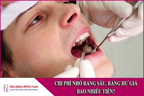 chi phí nhổ răng sâu, răng hư giá bao nhiêu tiền