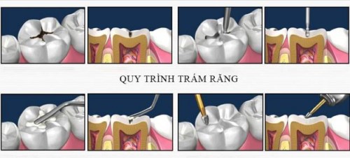 quy trinh tram rang