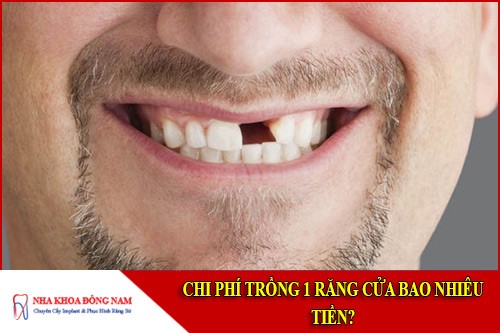 chi phí trồng 1 răng cửa bao nhiêu tiền