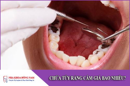 chữa tủy răng cấm giá bao nhiêu