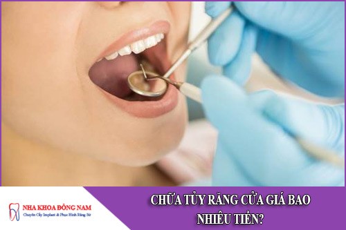 chi phí chữa tủy răng cửa giá bao nhiêu tiền