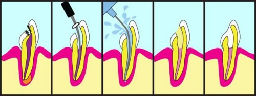 quá trình chữa tủy răng cửa