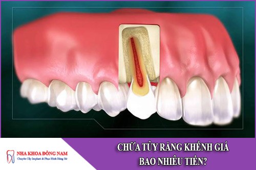 chữa tủy răng khểnh giá bao nhiêu tiền