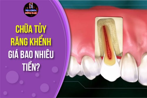 chữa tủy răng khểnh giá bao nhiêu tiền