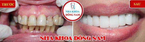 Khuyến mãi răng sứ nhân dịp khai xuân 2019 2