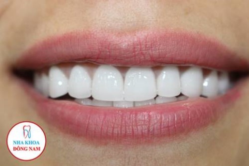 Khuyến mãi răng sứ hi-zirconia nhân dịp khai xuân 2019