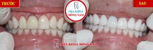Khuyến mãi răng sứ zirconia nhân dịp khai xuân 2019