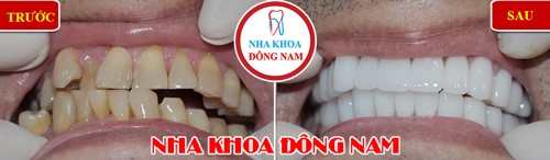 Khuyến mãi răng sứ emax nhân dịp khai xuân 2019