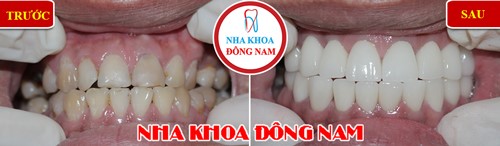 Khuyến mãi răng sứ emax nhân dịp khai xuân 2019 9