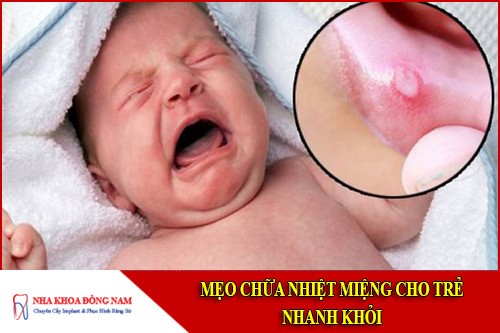 mẹo chữa nhiệt miệng cho trẻ nhanh khỏi