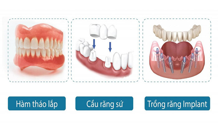 Mỗi một phương pháp trồng răng giả sẽ có chi phí khác nhau