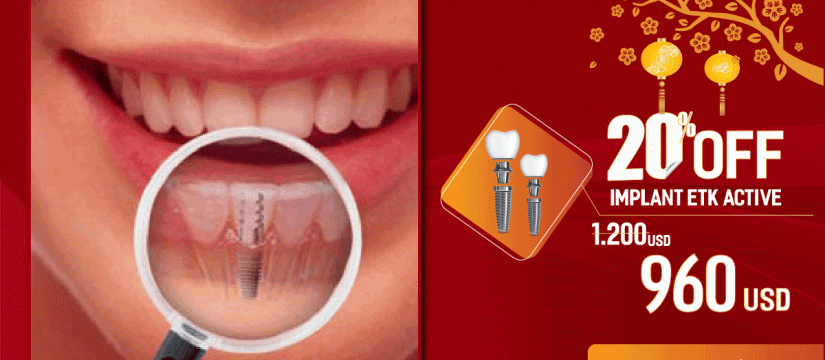 Nha khoa khuyến mãi cấy ghép implant nhân dịp khai xuân 2019