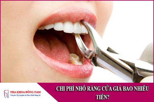 chi phí nhổ răng cửa giá bao nhiêu tiền