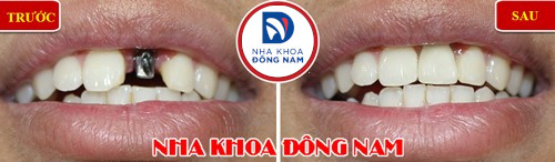 trồng implant răng cửa