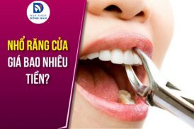 chi phí nhổ răng cửa giá bao nhiêu tiền