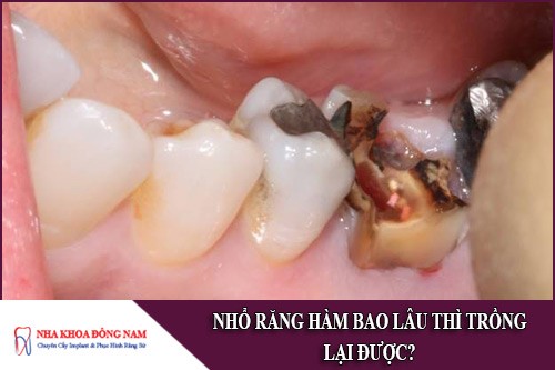 Nhổ răng hàm bao lâu thì trồng lại được