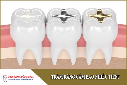 trám răng cấm bao nhiêu tiền