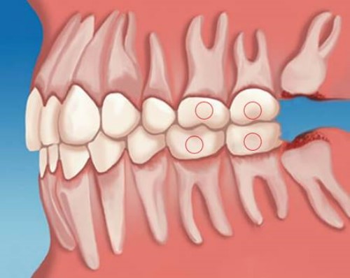 vị trí răng cấm trên cung hàm