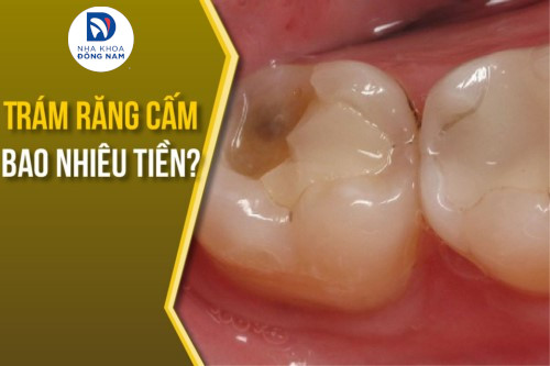 Cách trám răng cấm trám răng cấm an toàn và hiệu quả