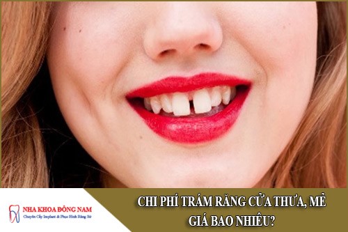 trám răng cửa thưa giá bao nhiêu