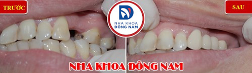bắc cầu sứ cho răng nhai