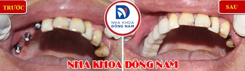 trồng răng implant cho răng nhai