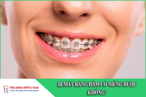 bị mất răng hàm có niềng răng được không