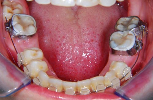 niềng răng khi bị mất răng