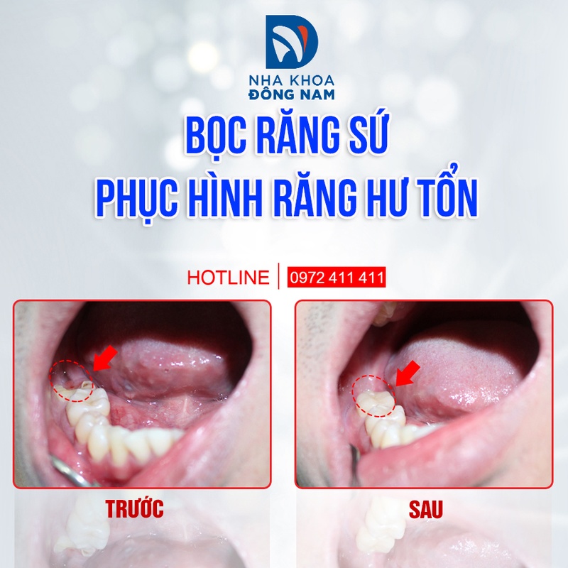 Bọc sứ cho răng hàm
