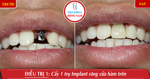 Cấy 1 trụ Implant răng cửa hàm trên
