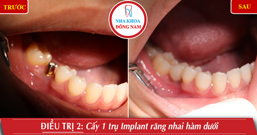 Cấy 1 trụ Implant răng nhai hàm dưới