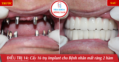 Cấy 16 trụ Implant cho bệnh nhân mất răng 2 hàm