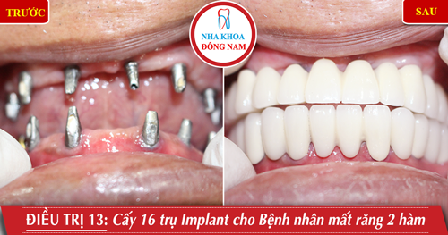 Cấy 16 trụ Implant cho bệnh nhân mất răng 2 hàm