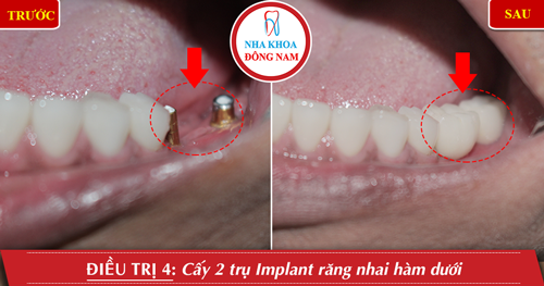 Cấy 2 trụ Implant răng nhai hàm dưới