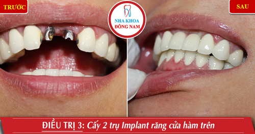 Cấy 2 trụ Implant răng cửa hàm trên