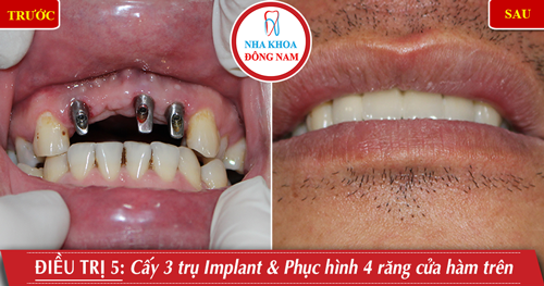 Cấy 3 trụ Implant gắn 4 răng cửa hàm trên