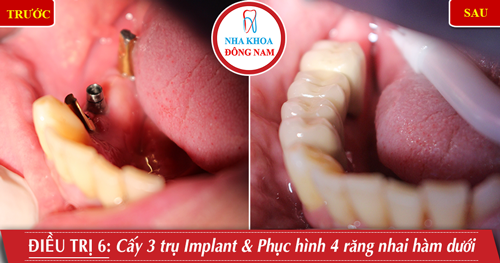 Cấy 3 trụ Implant gắn 4 răng nhai hàm dưới