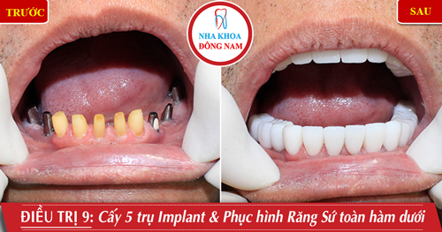 Cấy 5 răng Implant phục hình răng sứ toàn hàm dưới