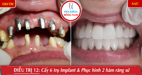 Cấy 6 trụ Implant phục hình 2 hàm răng sứ