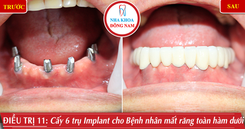 Cấy 6 trụ Implant và phục hình răng sứ hàm dưới