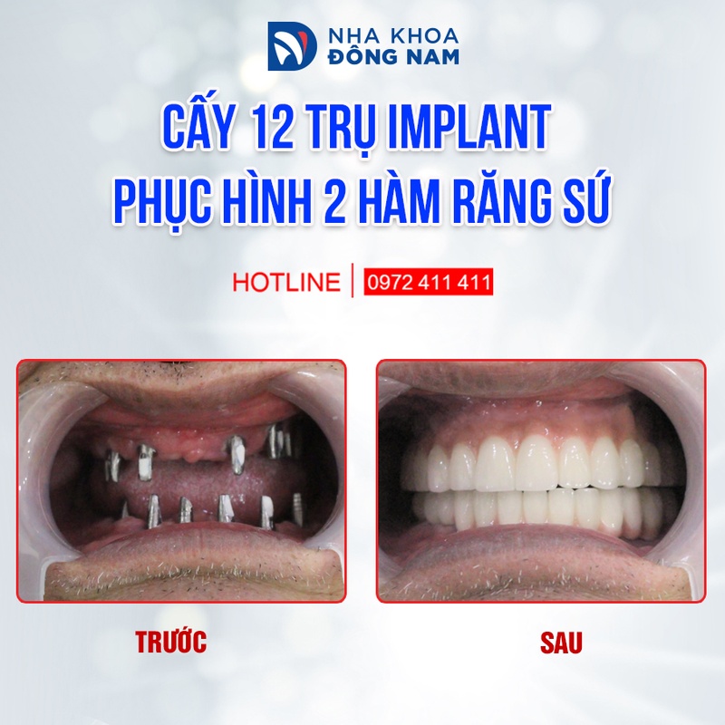 Cấy ghép Implant là giải pháp phục hình răng mất tốt nhất hiện nay