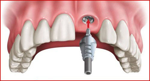 cấy ghép implant răng cửa giá bao nhiêu
