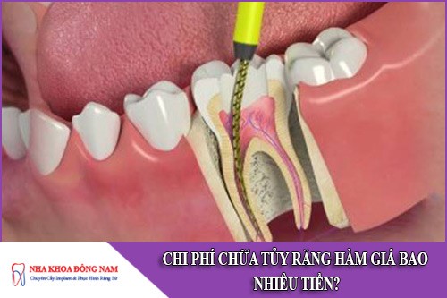 chi phí chữa tủy răng hàm giá bao nhiêu tiền