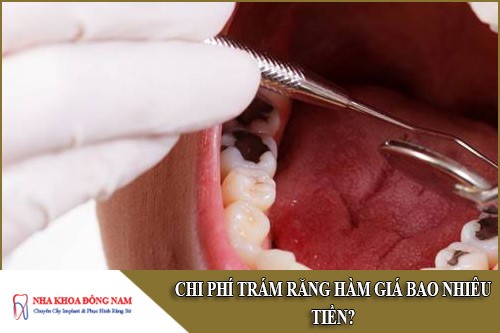 chi phí trám răng hàm giá bao nhiêu tiền