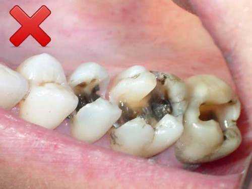 răng hàm bị sâu