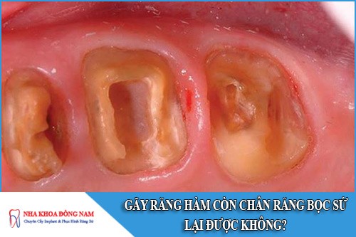 gãy răng hàm còn chân răng bọc sứ lại được không
