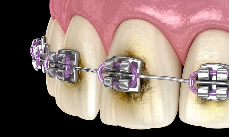 Không thể niềng răng nếu tình trạng men răng, xương hàm yếu