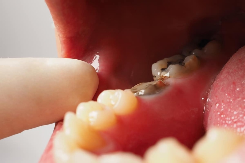 Mất răng hàm có thể do nhiều nguyên nhân khác nhau