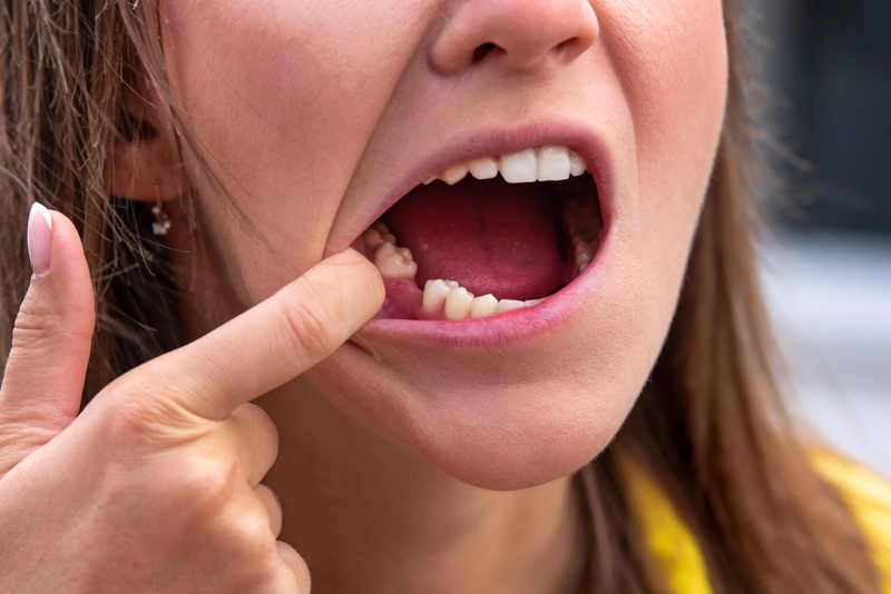 Mất răng hàm có thể gây tiêu xương hàm và nhiều ảnh hưởng tiêu cực đến sức khỏe