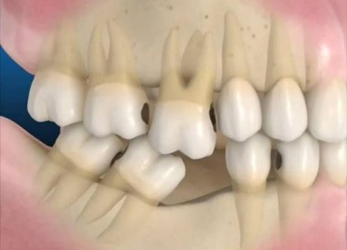 mất răng hàm lâu năm có trồng lại được không